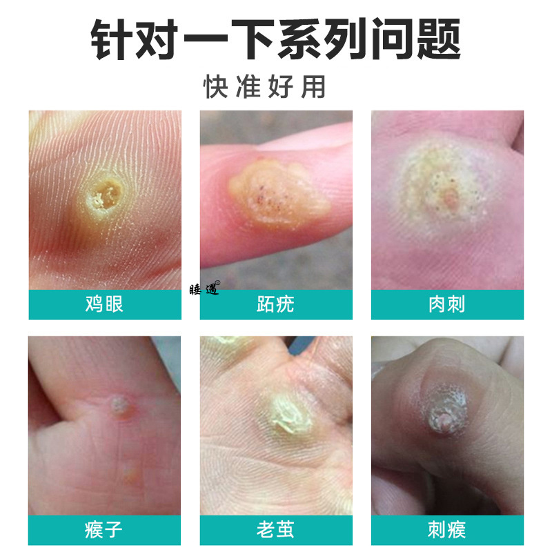 脚医生鸡尤净鸡眼膏贴去手足部脚底肉刺脚趾老茧脚垫跖趾疣套装
