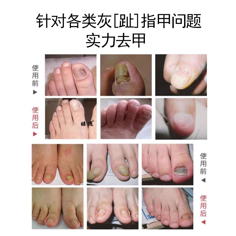灰指甲液套盒亮甲水去灰趾甲脱甲膏指甲增厚足部护理抑菌液