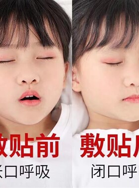 极速腺体样肥大面容矫p正器儿童宝宝睡觉张嘴呼吸不通气鼻塞嘴突