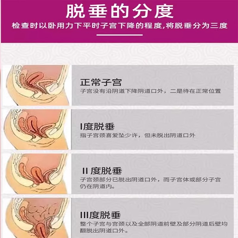 补中益气丸非北京同仁堂正品治子宫下垂妇科女性小腹坠痛子宫下坠