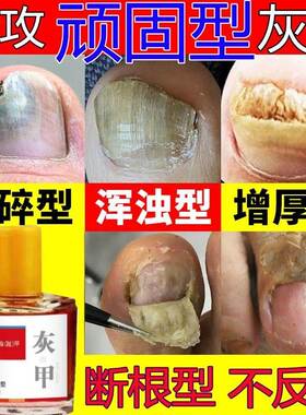 极速脚指甲增厚变黄灰甲神器脚趾甲变厚发黄变硬黄U指甲盖坏甲变