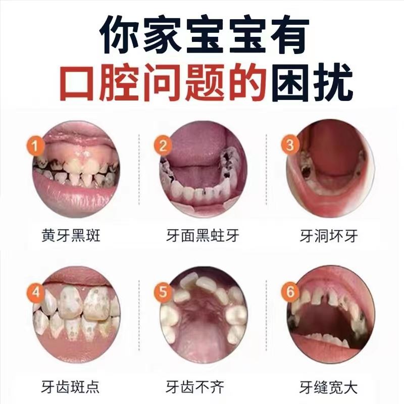 网红儿童牙菌斑祛除神器牙齿黑斑黑牙黑渍污垢去除清洁黄牙膏速效 - 图1