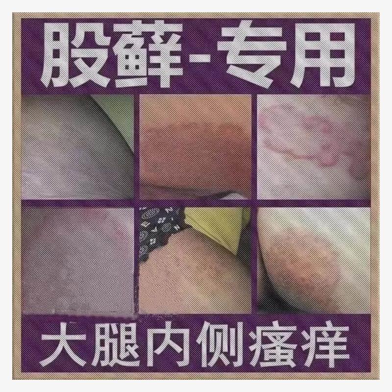 股藓大腿内侧根皮肤瘙痒真菌感染牛皮癣药体股癣去湿疹屁股止痒膏 - 图0