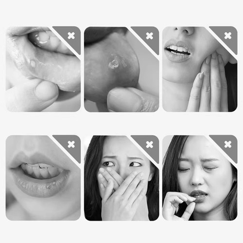 海氏海诺口腔溃疡凝胶独立包装15g/支修复和促进溃疡创面愈合舒缓 - 图2