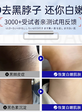 脖子黑棘皮症黑去除黑色脖子素去沉淀黑病药膏肥胖脖颈洗不干净