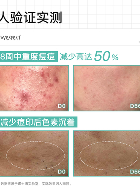 NOVEXPERT诺士博多效祛痘精华