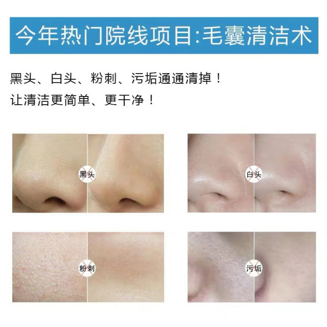 Hair follicle cleaning purifying cream salon ງາມພິເສດ facial facial sewage pore deep cleaning ຄີມນວດຝຸ່ນ