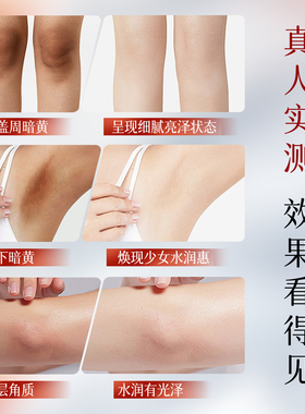 维A酸乳膏去角质提亮肤色
