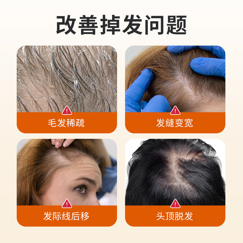 临期26.9米诺地尔酊2%女士生发液外用剂育脱发喷雾剂脂溢性皮炎,淘宝优惠券,粉丝福利购,淘宝优惠卷