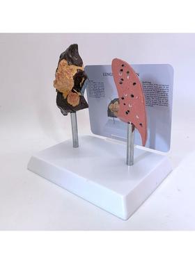 人体吸烟肺与健康肺对比模型 病理肺 肺泡解剖肺呼吸系统病变肺