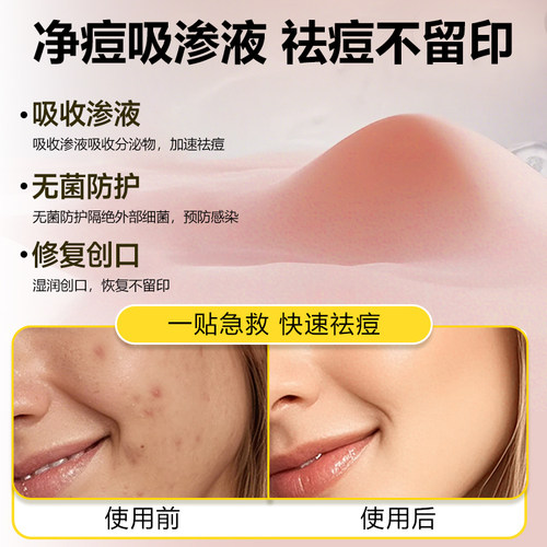 AUSLKA 180贴星星痘痘亲肤防水物理吸脓轻薄透气祛痘贴led灯镜盒 - 图0