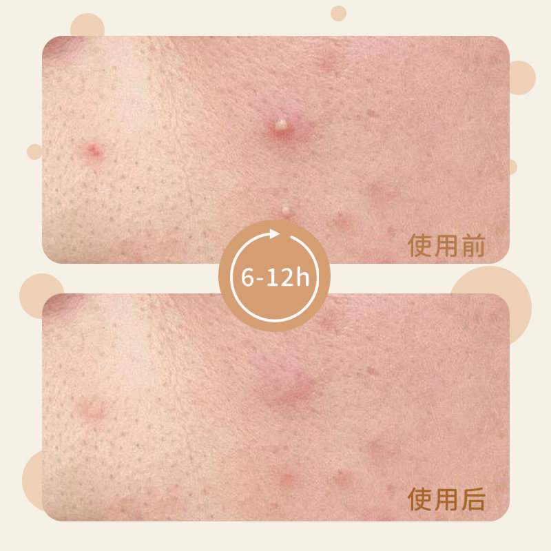 AUSLKA 240贴隐形祛痘贴遮瑕清洁吸脓修复抗痘不留疤防水可上妆,淘宝优惠券,粉丝福利购,淘宝优惠卷