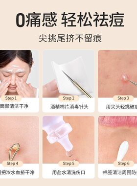 不锈钢粉刺针暗疮针粉刺挤压器痘
