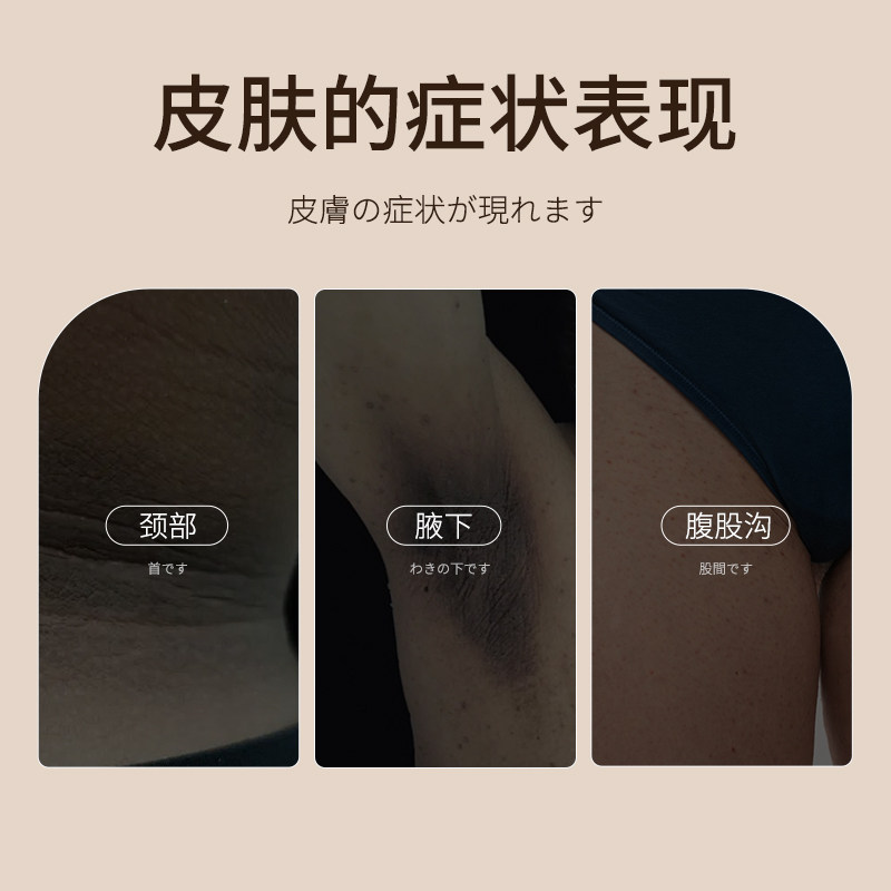 脖子黑黑棘皮症去除脖子黑色素沉淀去黑病药膏肥胖脖颈洗不干净