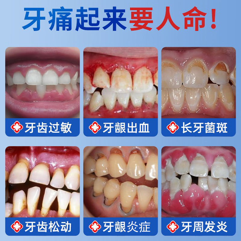 孚可安医用牙齿脱敏剂非牙膏治口腔脱敏膏牙龈萎缩修复牙周炎专用