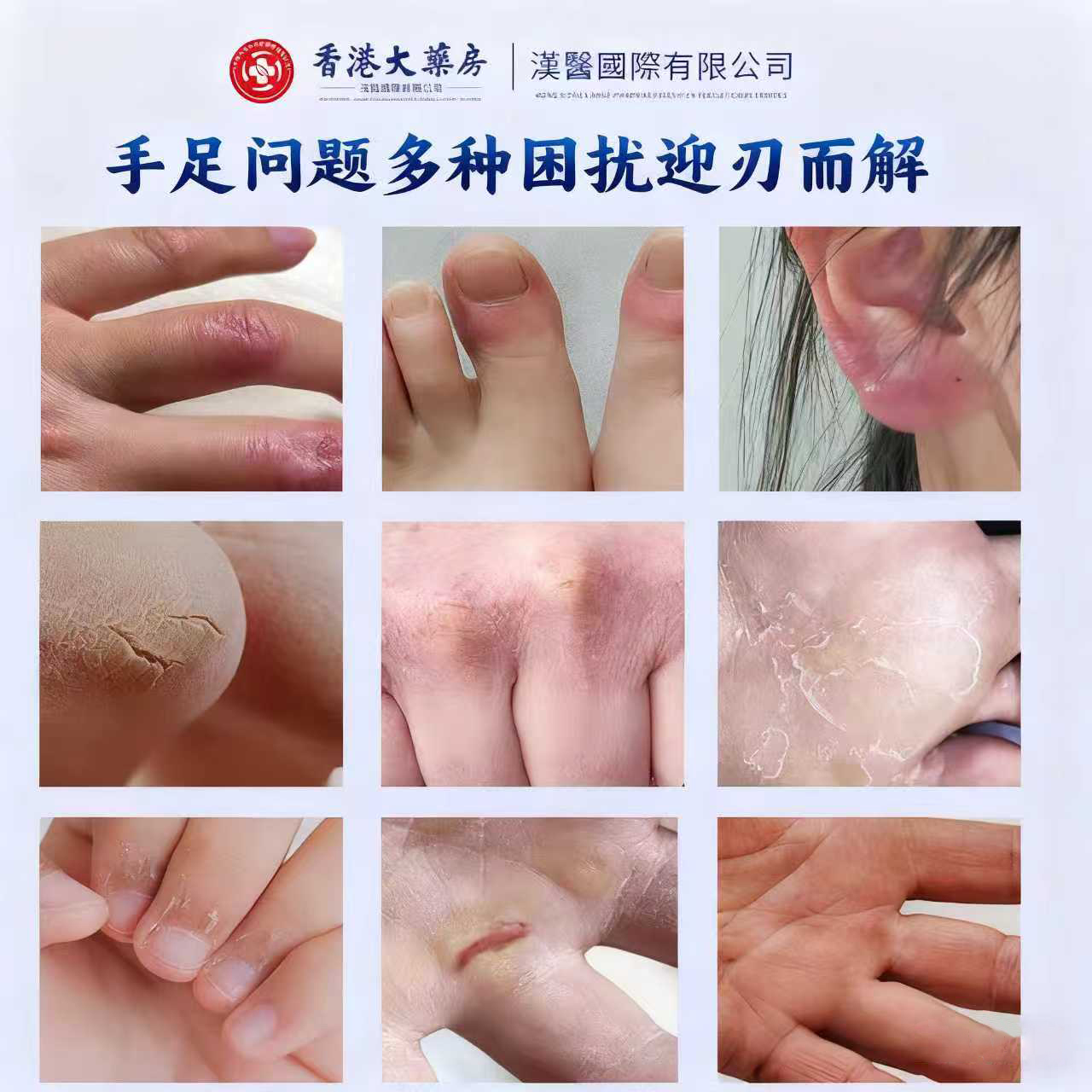 【官方正品旗舰店】干裂冻疮膏母婴孕妇均可使用A2