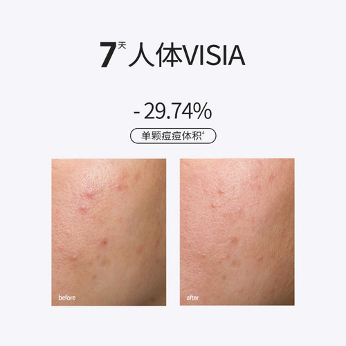 Sounder One20%壬二酸密集焕颜乳霜祛痘控油舒缓SOUNDER ONE - 图0