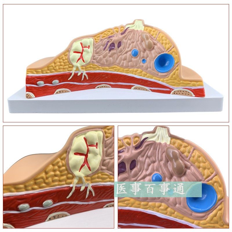 义乳病变模型 女性月嫂培训病理模型 催乳师护理模型 培训模具,淘宝优惠券,粉丝福利购,淘宝优惠卷