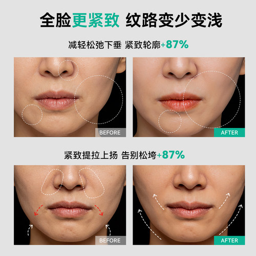 索朗特V脸仪智能脉冲塑颜仪V脸神器绷带脸部提拉紧致面部法令纹 - 图3