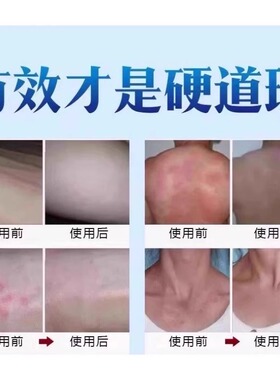 康王老牌子醋酸氯已定肤舒痒膏