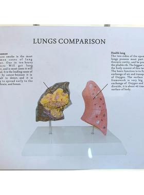 人体吸烟肺与康肺对比健模型病VSQ理肺肺解剖泡肺呼吸系统病变肺