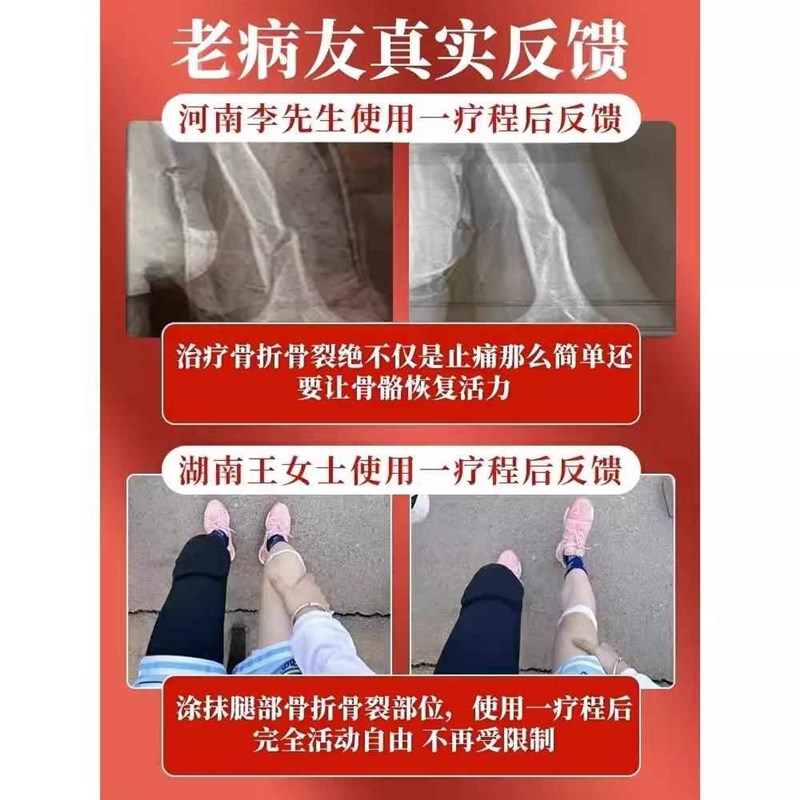 骨折骨裂恢复药膏快速接骨愈合活血化瘀伤筋动骨跌打损伤消肿止痛 - 图0