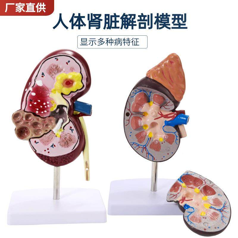 人体肾肾脏型肾解剖肾上腺放大模型877病变脏人体内脏器官解模附,淘宝优惠券,粉丝福利购,淘宝优惠卷