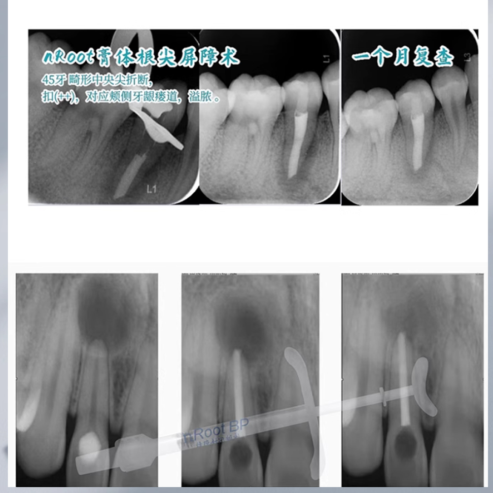 牙科恩普诺nROOT BP生物陶瓷根管封闭糊剂陶瓷根管修复替代iroot - 图1