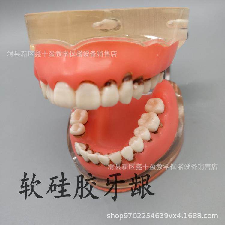 牙科病牙理模型结牙石萎缩55870牙龈缺失牙牙周洁治术练周习软牙,淘宝优惠券,粉丝福利购,淘宝优惠卷