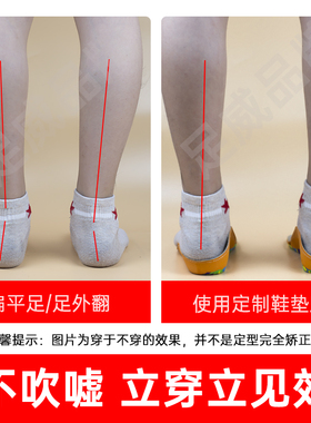 儿童内八字矫正鞋垫扁平足足外翻矫正器3D定制XO型腿矫正长短腿鞋