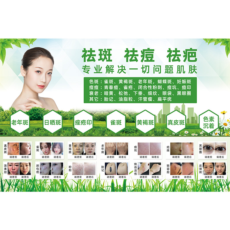 祛斑海报祛痘祛皱祛疤对比图美容院宣传广告图斑敏痘海报挂图墙贴 - 图3
