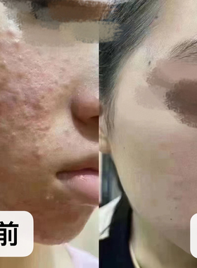 手工祛粉刺痘痘珍珠膏痘痘黑头可改善，提亮肤色，10克