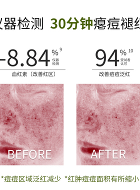 【新品】欣兰复合酸祛痘面膜杏仁酸控油祛痘淡化痘印舒缓冻膜50g
