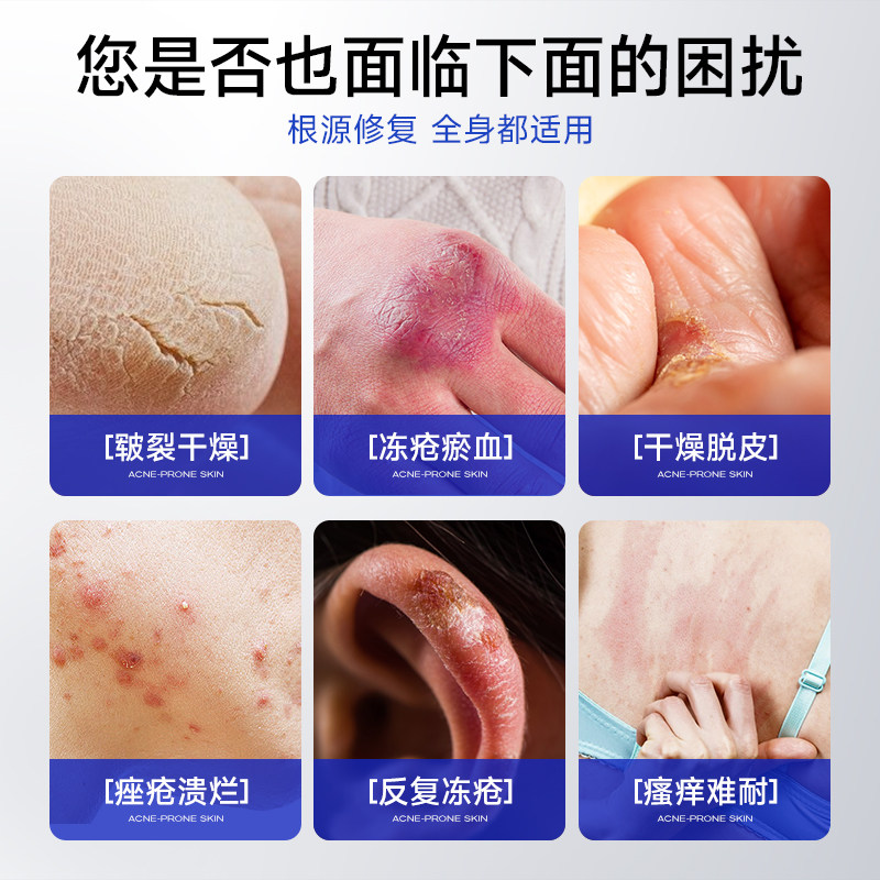 医用冻疮膏止痒冻伤膏耳朵消肿儿童防冻防裂正品特效修复护手足霜,淘宝优惠券,粉丝福利购,淘宝优惠卷