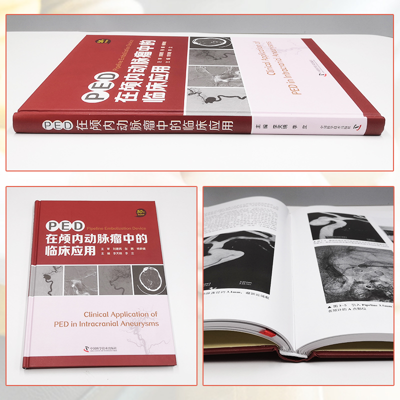正版 PED在颅内动脉瘤中的临床应用 50个经典案例 李晓天 李立 主编 脑实质出血 Pipeli - 图0