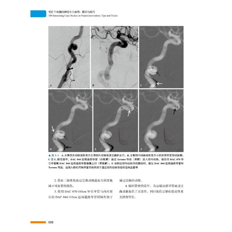 100个有趣的神经介入病例 提示与技巧 - 图2