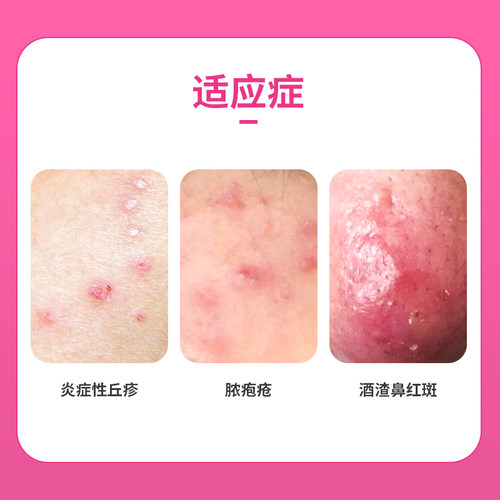 丽芙甲硝唑凝胶祛痘药膏闭口粉刺甲硝锉正品和壬二酸乳膏 - 图3
