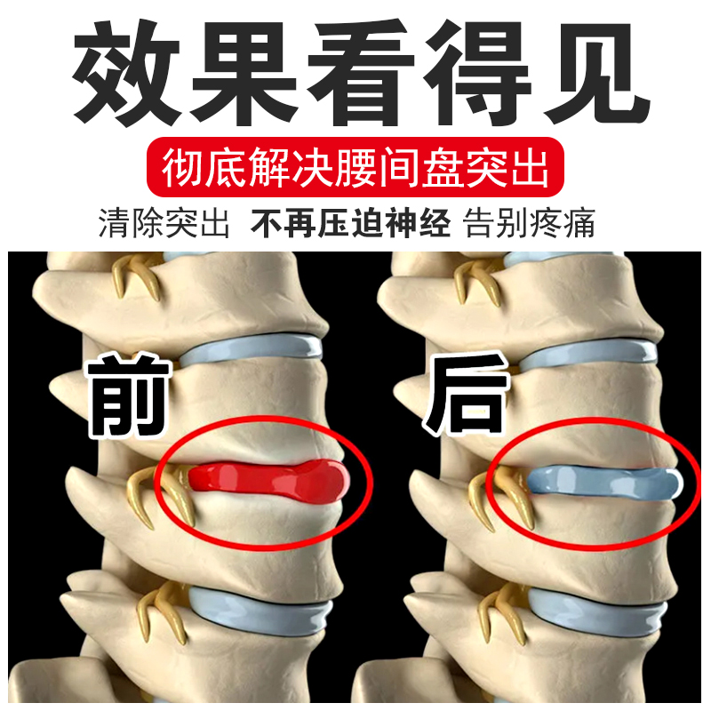 【一辈子不疼】腰突压迫神经腰椎腿麻腰肌劳损腰专用药治腰疼痛MH - 图0