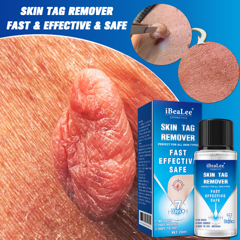 7Days Skin Tag Removal Serum Warts Remover Pen Painless Papi-图0