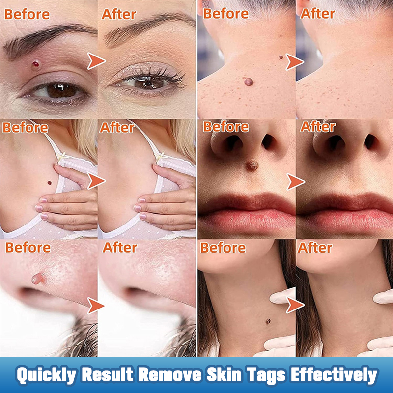 7Days Skin Tag Removal Serum Warts Remover Pen Painless Papi-图1