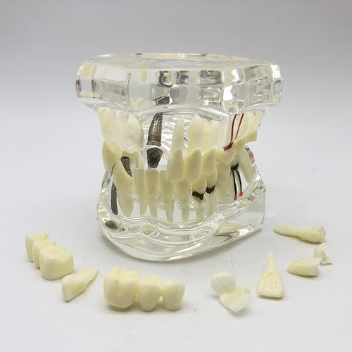 牙科材料 修复牙模型 水晶病理牙模型 活动种植牙模型 包邮 - 图0
