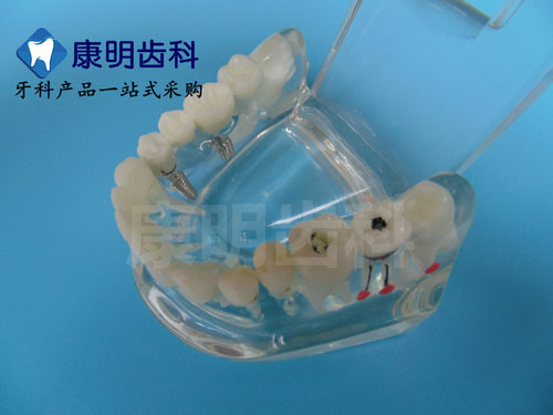牙科材料 修复牙模型 水晶病理牙模型 活动种植牙模型 包邮 - 图3