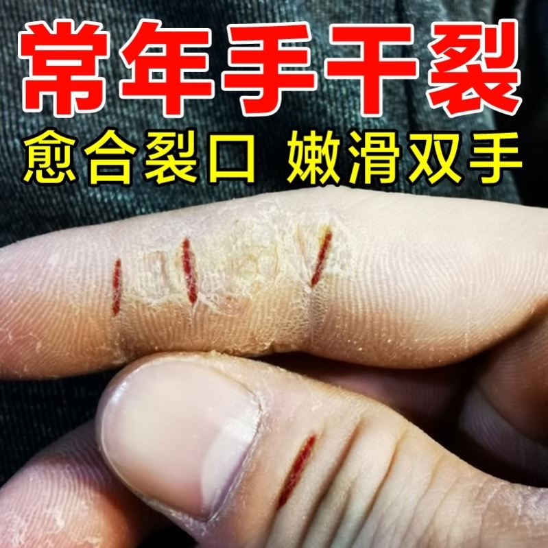 南京同仁堂脚后跟干裂去死皮神器防裂膏手足手指开裂修复霜旗舰店 - 图0