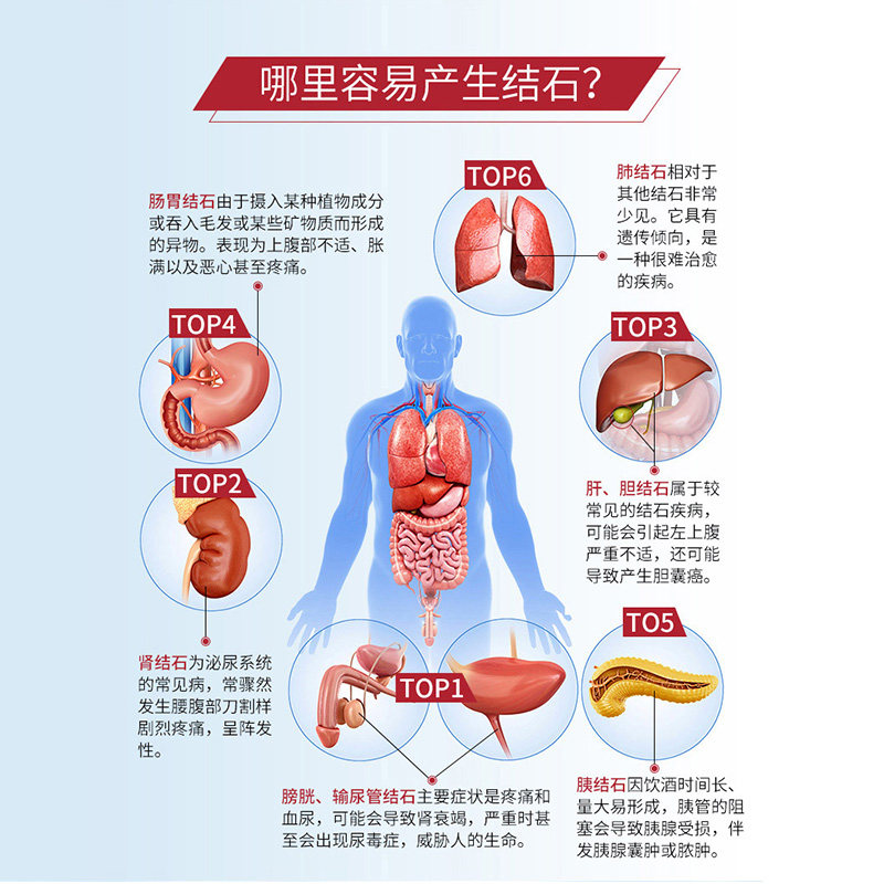万宁善理疗德国强力消石素排石胶囊 万宁海外国际肝胆药品