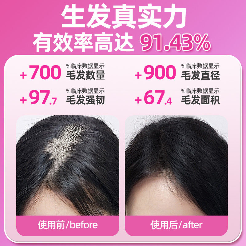 仁和米诺地尔搽剂2%女性防脱发药生发液育发洗发水官方旗舰店正品