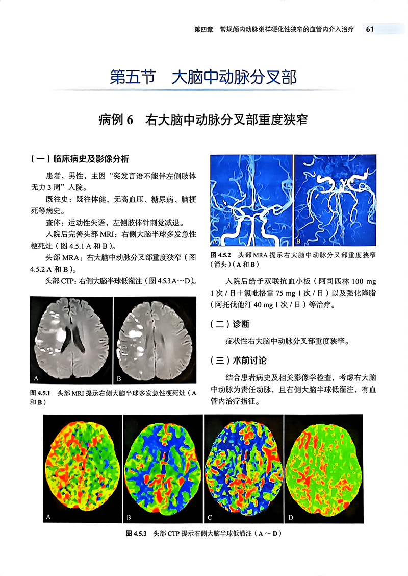 颅内动脉粥样硬化性狭窄血管内介入治疗 马宁 中英双语对照ICAS研究血管内治疗技术临床精选病例 北京大学医学出版社9787565926969 - 图2