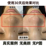 Hanji Tea Tree Tree The Chlackhead Cabinet Официальная аутентичная коллекция пор Deep Cleaning Cinemas Special Xza31