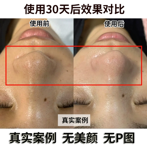 Hanji Tea Tree Tree The Chlackhead Cabinet Официальная аутентичная коллекция пор Deep Cleaning Cinemas Special Xza31