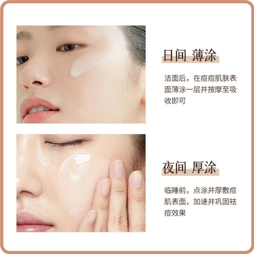 祛痘精华霜去闭口溶解粉刺黑头痘痘肌肤淡化痘印祛痘霜王二酸,淘宝优惠券,粉丝福利购,淘宝优惠卷