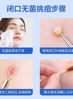 粉刺针闭口针一次性清痘祛痘排痘暗疮针美容院专用专业超细挑痘针